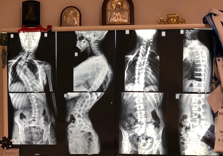 Новосибирские нейрохирурги провели сложную операцию 13-летней пациентке со сколиозом четвёртой степени