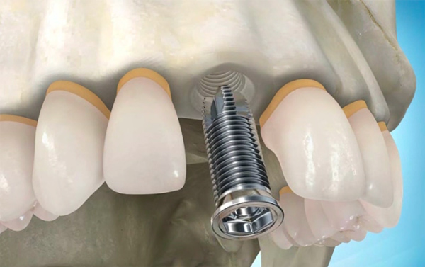 О чём нужно знать, соглашаясь на имплантацию зубов
