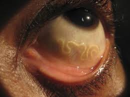 Офтальмологи удалили россиянке из глаза червя, длиной 8 сантиметров