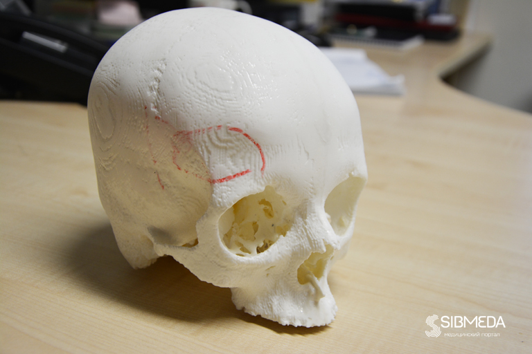 Исправление дефектов костей черепа: аспекты современной нейрохирургии