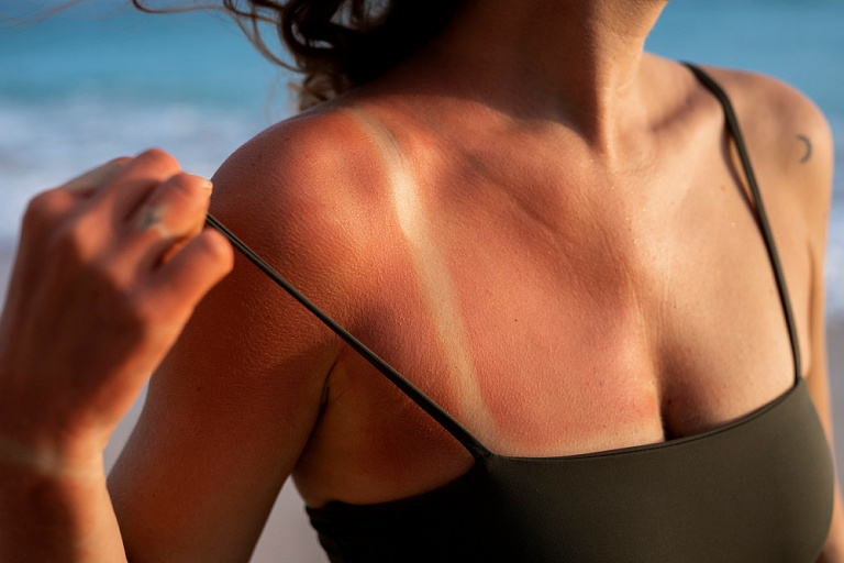Как правильно ухаживать за обгоревшей на солнце кожей?